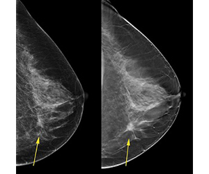 When it’s time for a mammogram, should you ask for 3D?